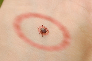 Ticks And How To Prevent Lyme Disease
